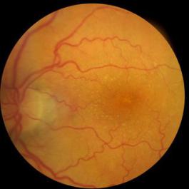 Der Augenhintergrund ist nur am weitgetropften Auge komplett einsehbar